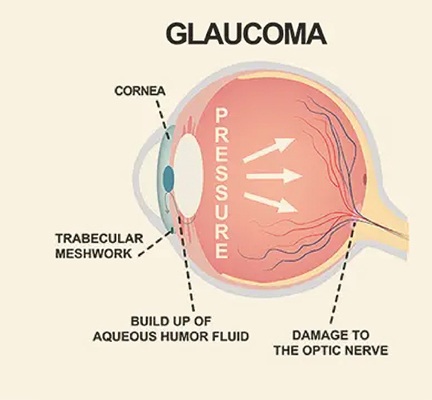 Glaucoma Management
