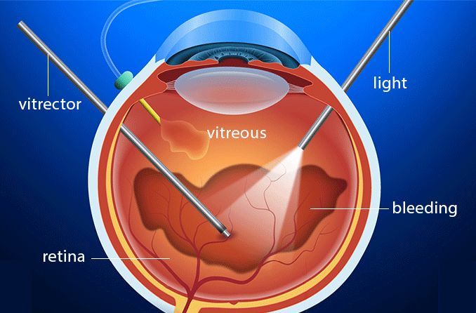 Retina & Vitreous Care